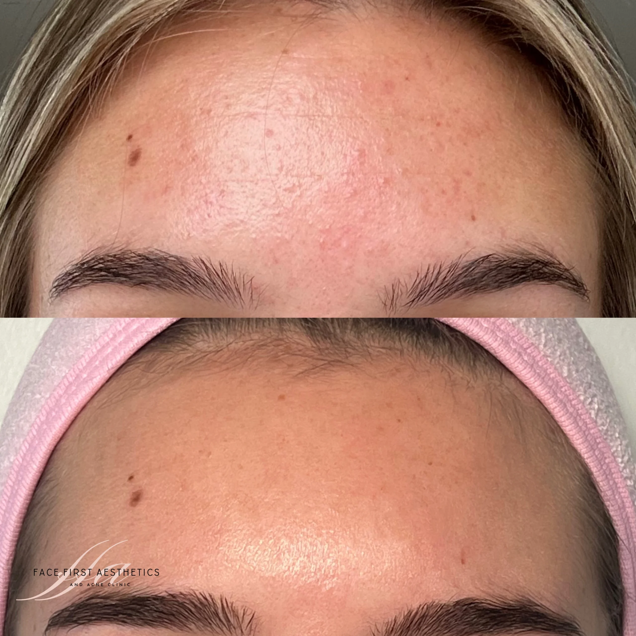 Acne Bootcamp before & after