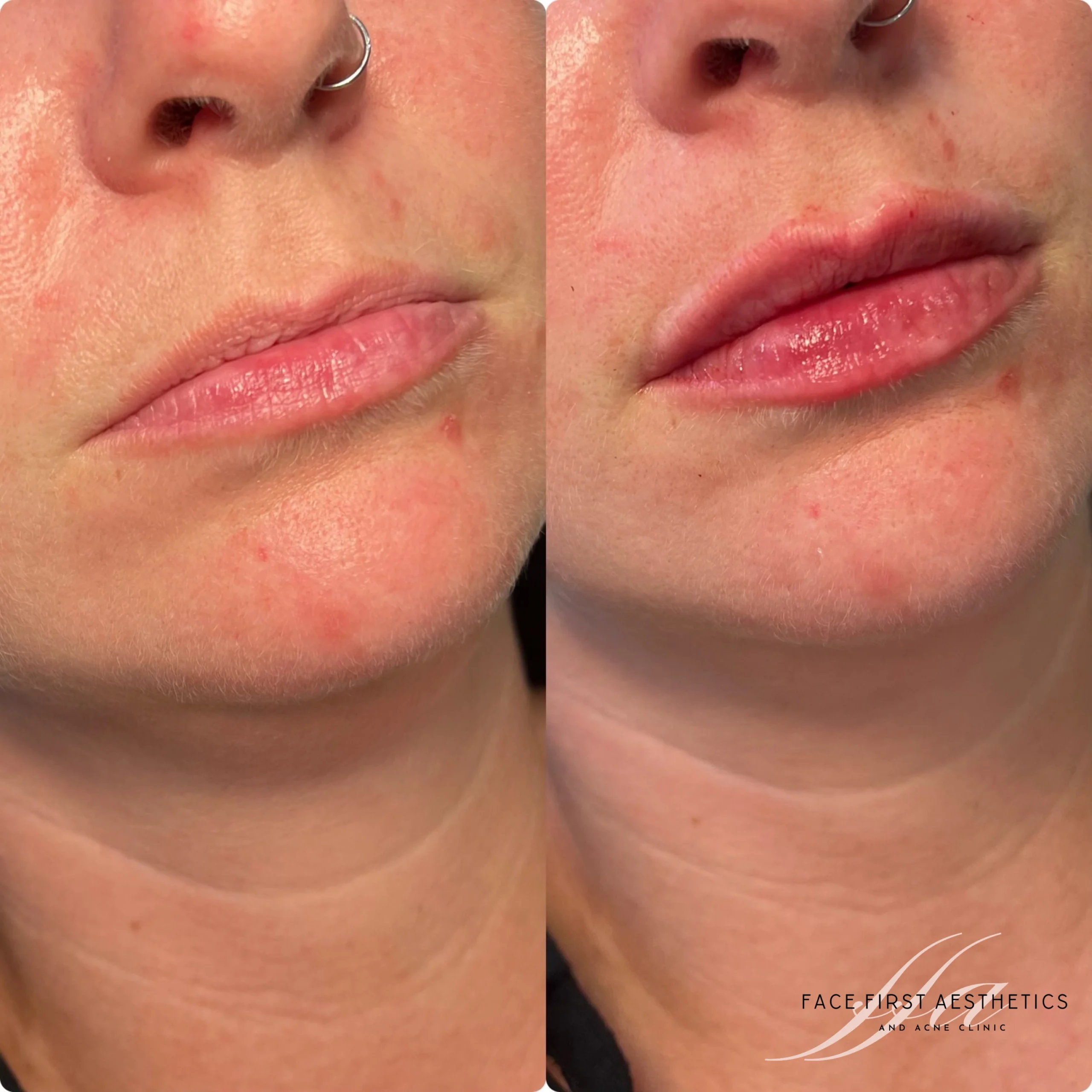 Lip filler before & after