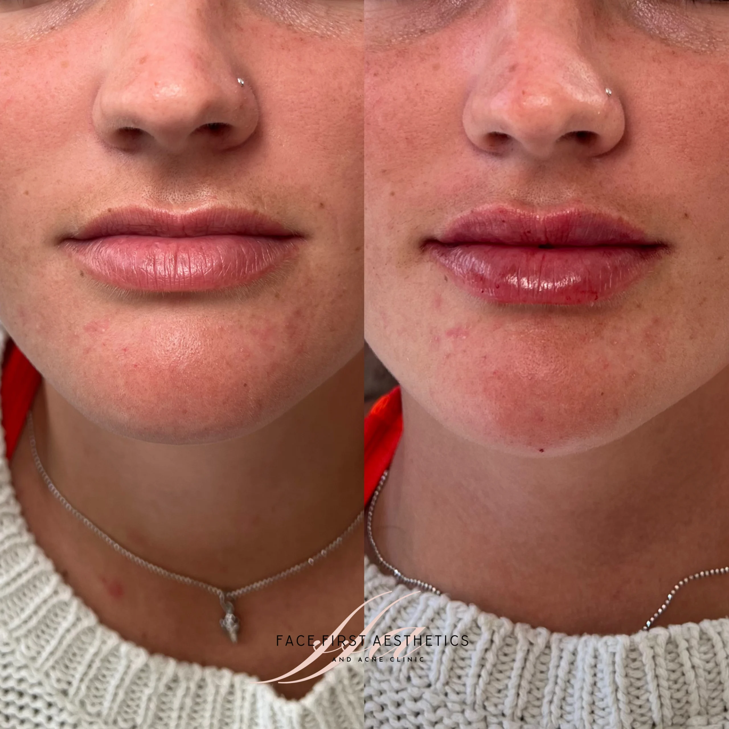 lip filler before & after